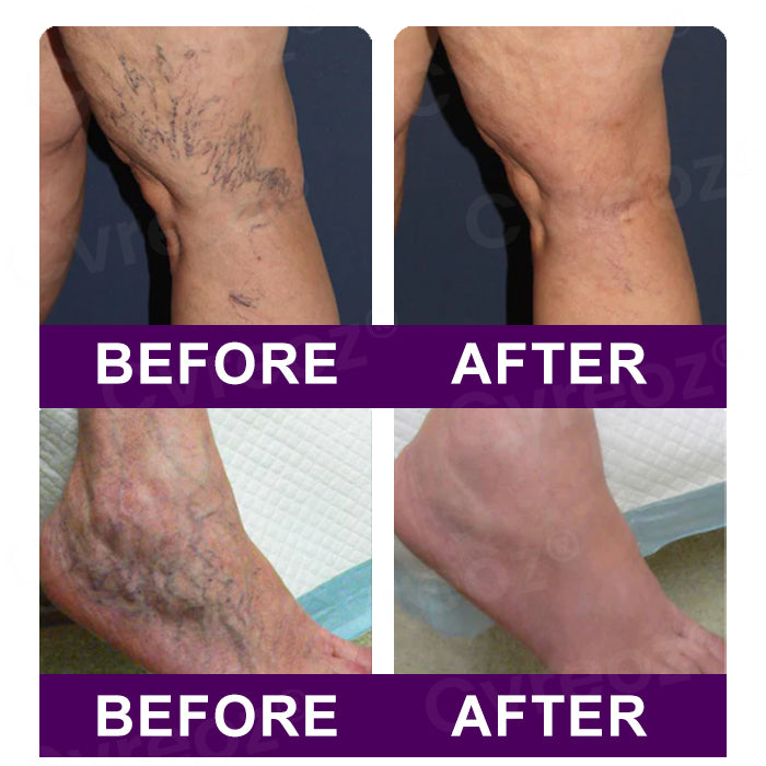 🔥Hot Sales - 50% OFF🔥Cvreoz® Polidocanol Nano Patches for Varicose Veins