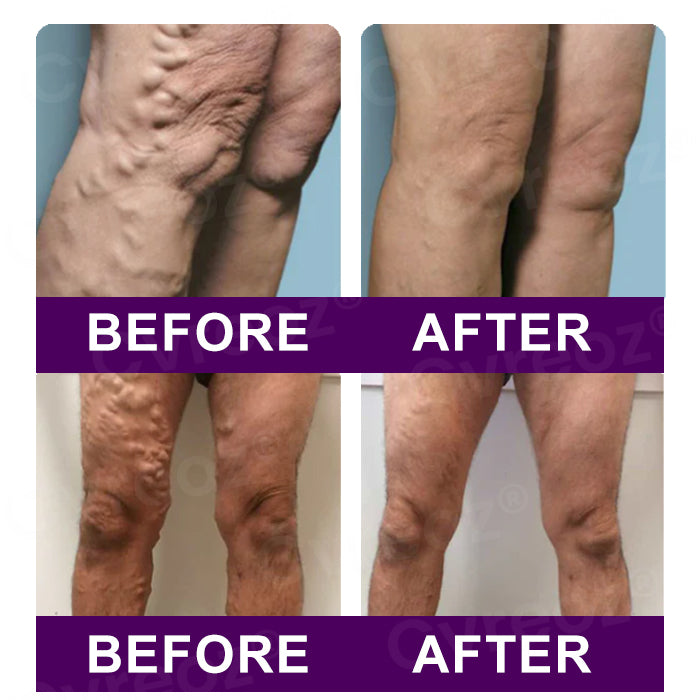 🔥Hot Sales - 50% OFF🔥Cvreoz® Polidocanol Nano Patches for Varicose Veins