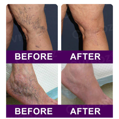 🔥Hot Sales - 50% OFF🔥Cvreoz® Polidocanol Nano Patches for Varicose Veins