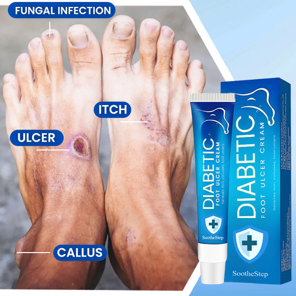 SootheStep™ Diabetic Foot Ulcer Cream