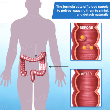 AEXZR™ Colon and Polyps Removal Cure