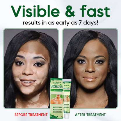 AEXZR™ Vitiligo Therapeutic Cream