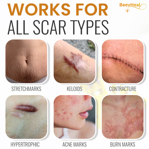 BeevHeal™ Scar Removal Spray