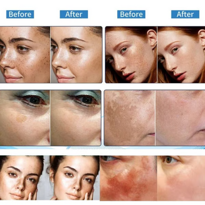 🔥 AEXZR™ Vitamin C Whitening Freckles Face Cream Remove Melasma Dark Spots Lighten Melanin