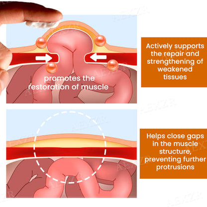 Enzyil™ Hernia Treatment Cream