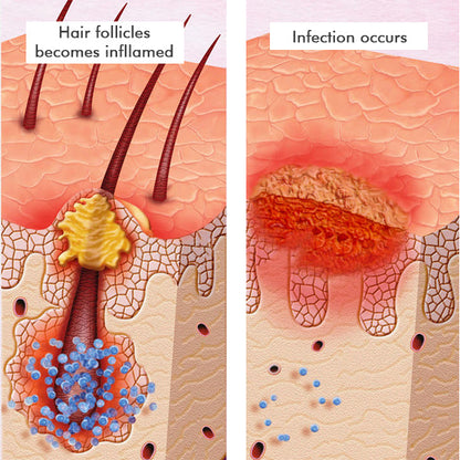 AEXZR™ Folliculitis Clearing Spray