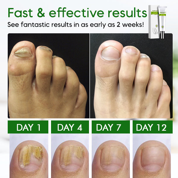 AEXZR™ Toe Nail Treatment Gel