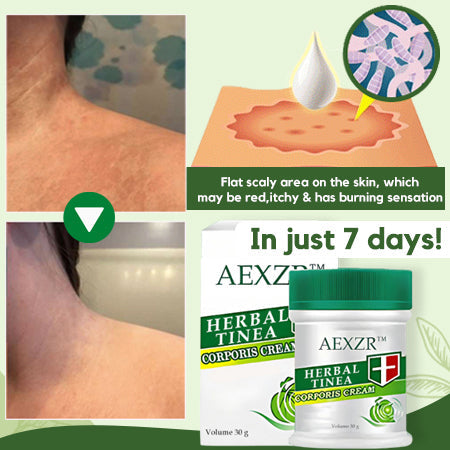 AEXZR™ Herbal Tinea Corporis Cream